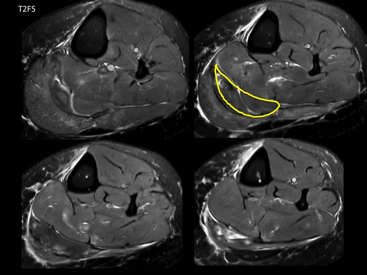 Figure 4 for case medial head of gastrocnemius muscle ( RID2921 )